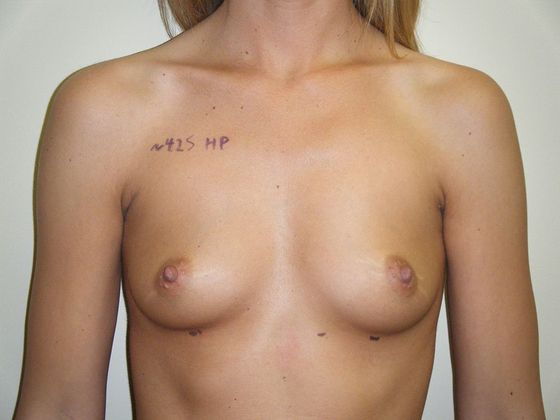 Before breast augmentation photo